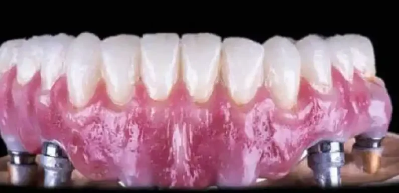 The Role of Osseointegration in Implants